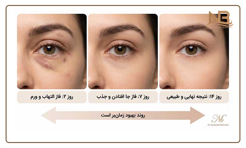 اثر فیلر زیر چشم کی مشخص میشود؟ 11 فیلر زیر چشم چند روز بعد اثر میکند؟