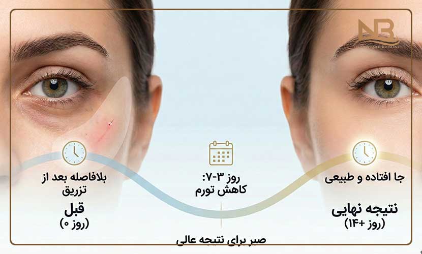 اثر فیلر زیر چشم کی مشخص میشود؟ 12 عوامل تأثیرگذار بر سرعت و کیفیت اثرگذاری فیلر زیر چشم