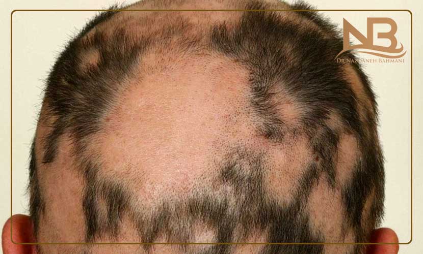 راه درمان ریزش مو سکه ای یا آلوپسی چیست؟ 26 درمان ریزش مو سکه ای