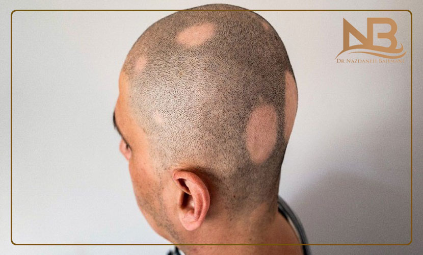راه درمان ریزش مو سکه ای یا آلوپسی چیست؟ 27 ریزش مو سکه ای
