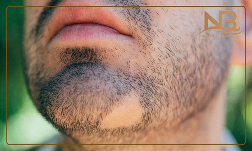 راه درمان ریزش مو سکه ای یا آلوپسی چیست؟ 28 درمان ریزش مو سکه ای