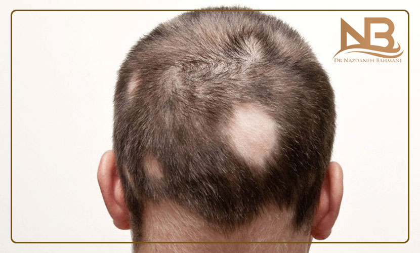 راه درمان ریزش مو سکه ای یا آلوپسی چیست؟ 29 ریزش مو سکه ای