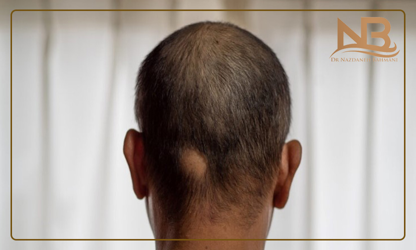 راه درمان ریزش مو سکه ای یا آلوپسی چیست؟ 30 درمان ریزش مو سکه ای