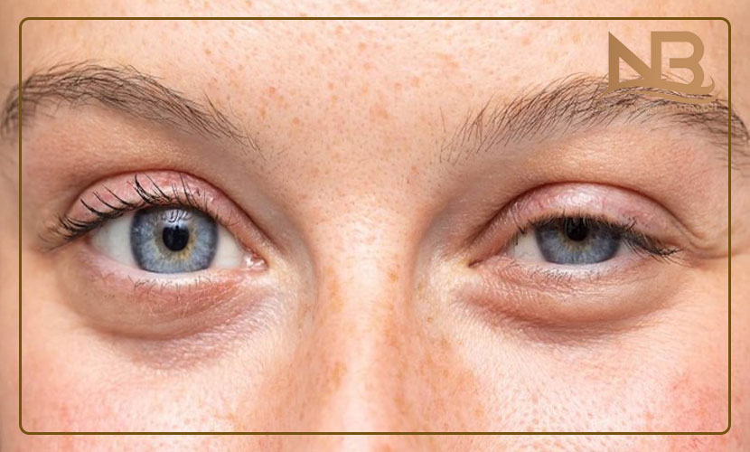 عوارض بوتاکس چیست و چگونه درمان می شود؟ 17 عوارض بوتاکس