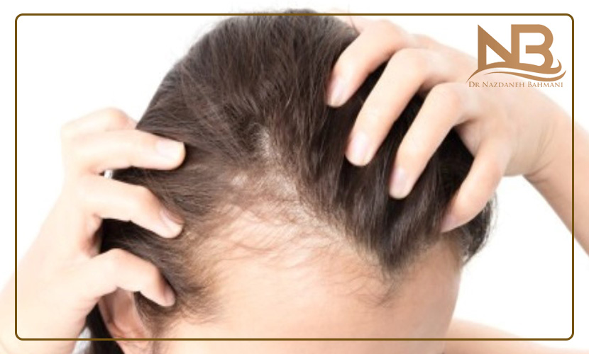 علت انواع مختلف ریزش مو چیست (راههای جلوگیری علت ریزش مو) 21 علت ریزش مو
