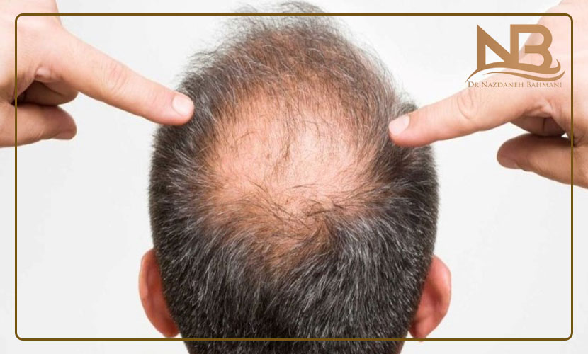 علت انواع مختلف ریزش مو چیست (راههای جلوگیری علت ریزش مو) 22 علت ریزش مو