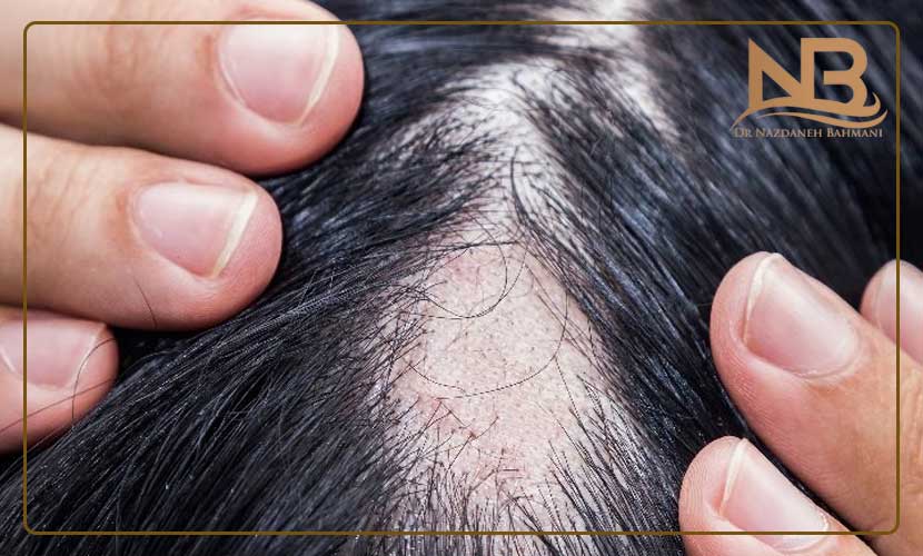 علت انواع مختلف ریزش مو چیست (راههای جلوگیری علت ریزش مو) 23 علت ریزش مو