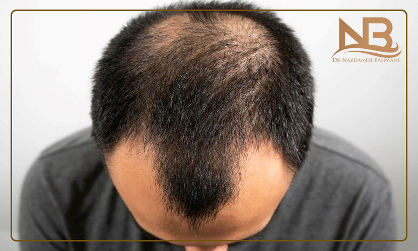 علت انواع مختلف ریزش مو چیست (راههای جلوگیری علت ریزش مو) 24 علت ریزش مو