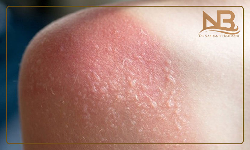 عوارض لیزر موهای زائد 31 عوارض لیزر موهای زائد