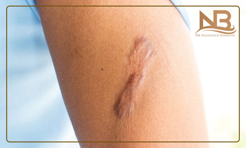 عوارض لیزر موهای زائد 33 عوارض لیزر موهای زائد