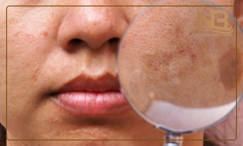 عوارض لیزر موهای زائد 34 عوارض لیزر موهای زائد