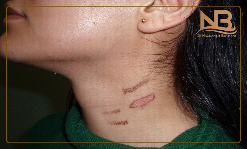 عوارض لیزر موهای زائد 35 عوارض لیزر موهای زائد