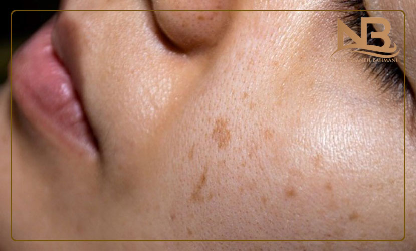 عوارض لیزر موهای زائد 36 عوارض لیزر موهای زائد