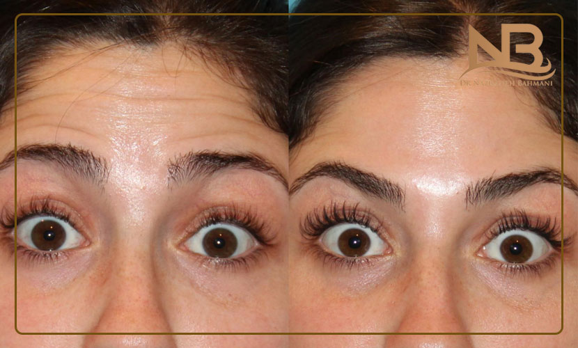 مراقبت های بعد از بوتاکس پیشانی و دور چشم 23 مراقبت های بعد از بوتاکس پیشانی و دور چشم