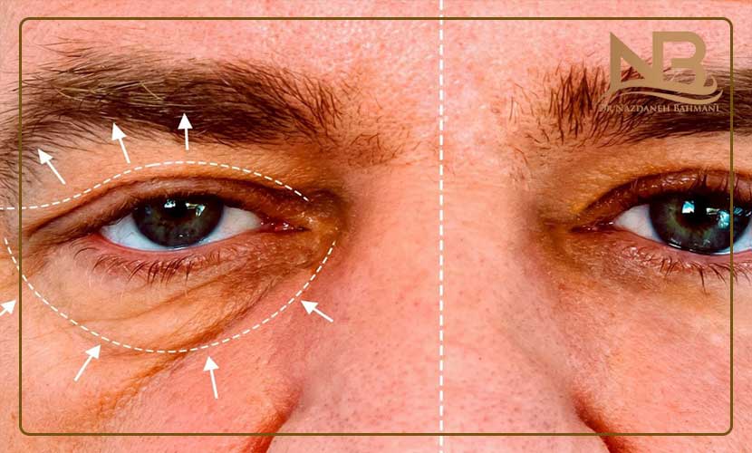 مراقبت های بعد از بوتاکس پیشانی و دور چشم 21 مراقبت های بعد از بوتاکس پیشانی و دور چشم