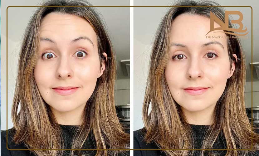 مراقبت های بعد از بوتاکس پیشانی و دور چشم 24 مراقبت های بعد از بوتاکس پیشانی و دور چشم