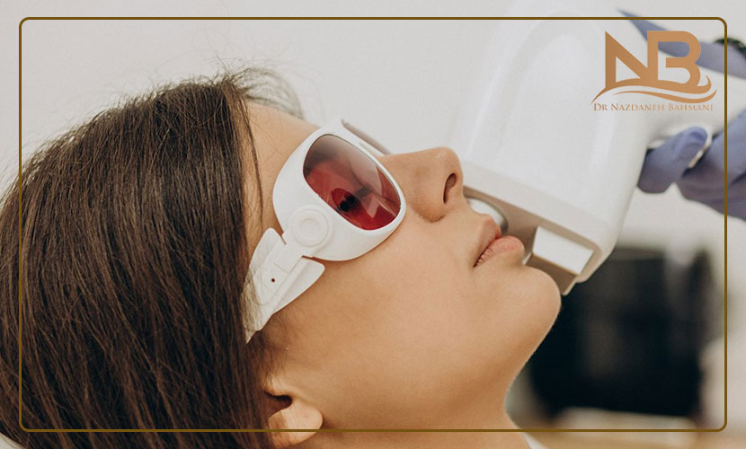 لیزر موهای صورت