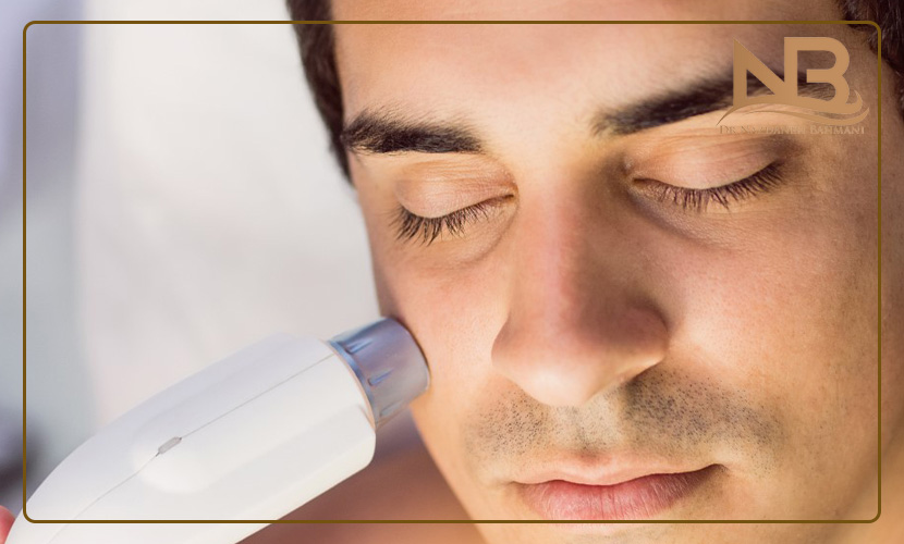 لیزر موهای صورت