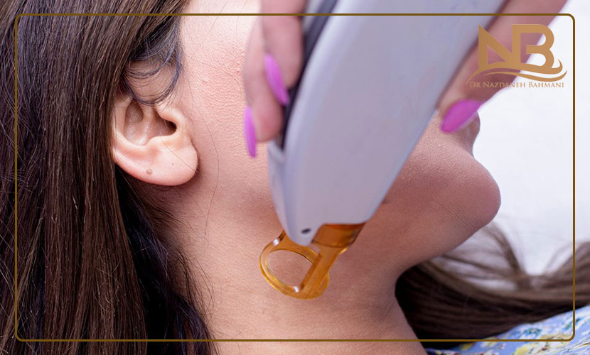 لیزر موهای صورت