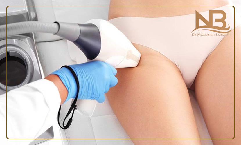 لیزر موی زائد واژن