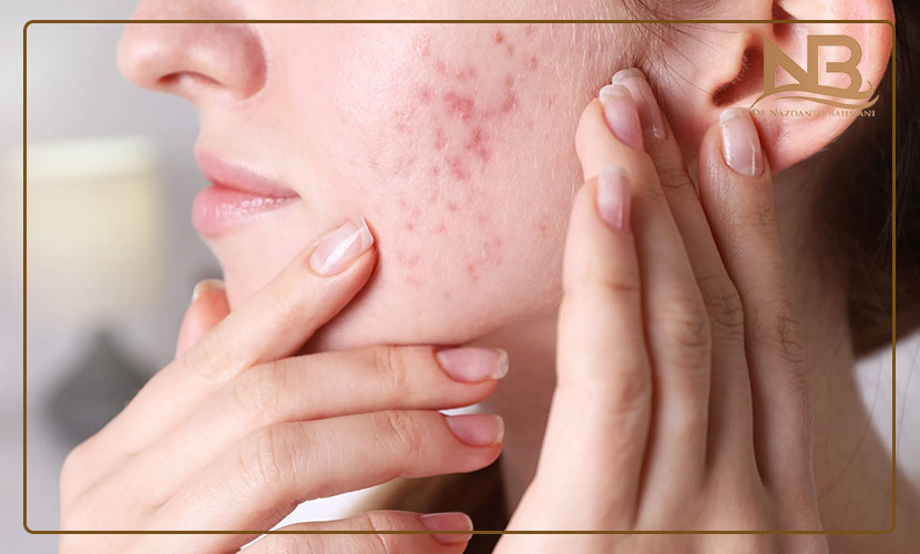 Microneedling acne scars 1