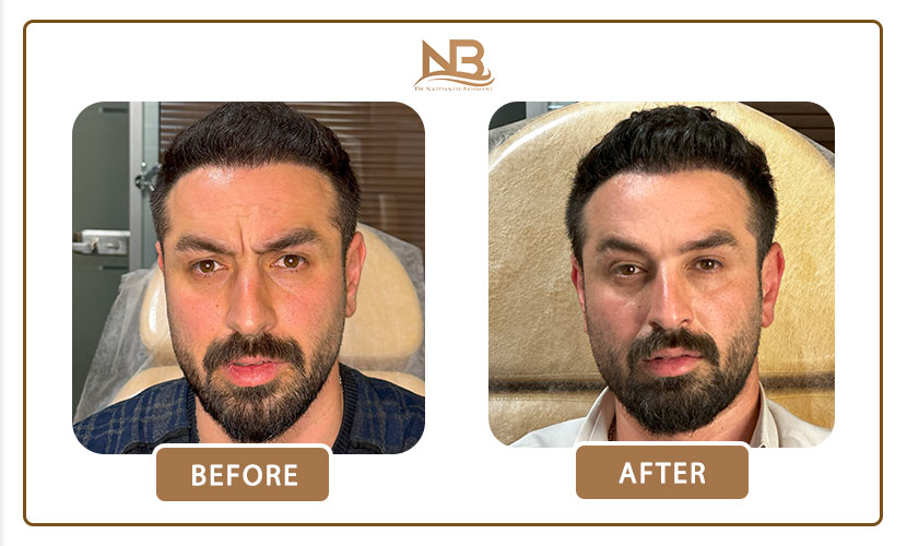 تزریق بوتاکس خط اخم 3 نمونه کار بوتاکس خط اخم 2