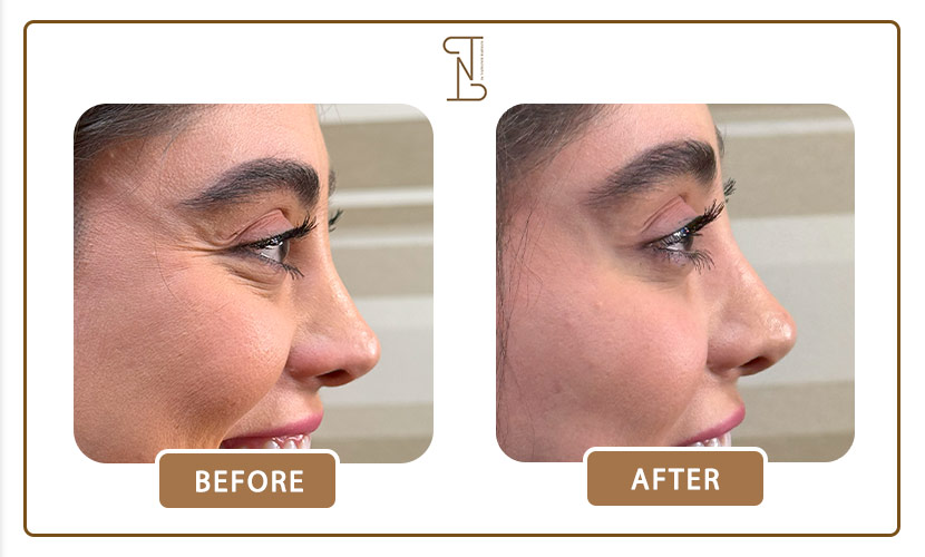 تزریق بوتاکس دور چشم 7 نمونه-کار-بوتاکس-دور-چشم-5