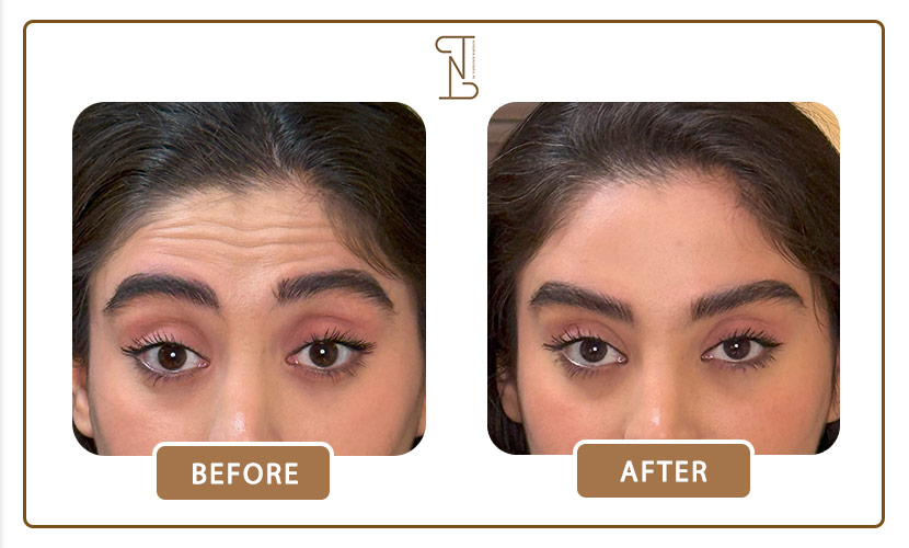 نمونه-کار-بوتاکس-پیشانی-3