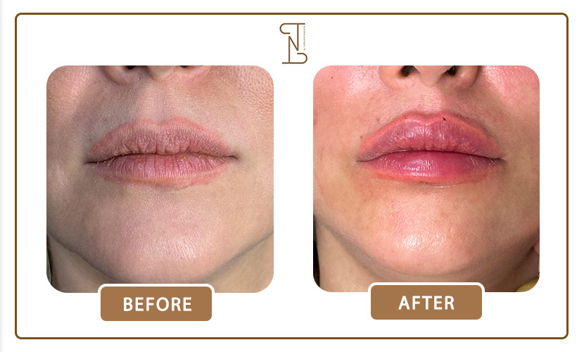 نمونه-کار-فیلر-لب-14