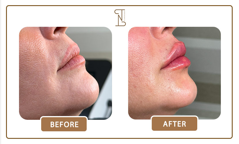 نمونه-کار-فیلر-لب-15