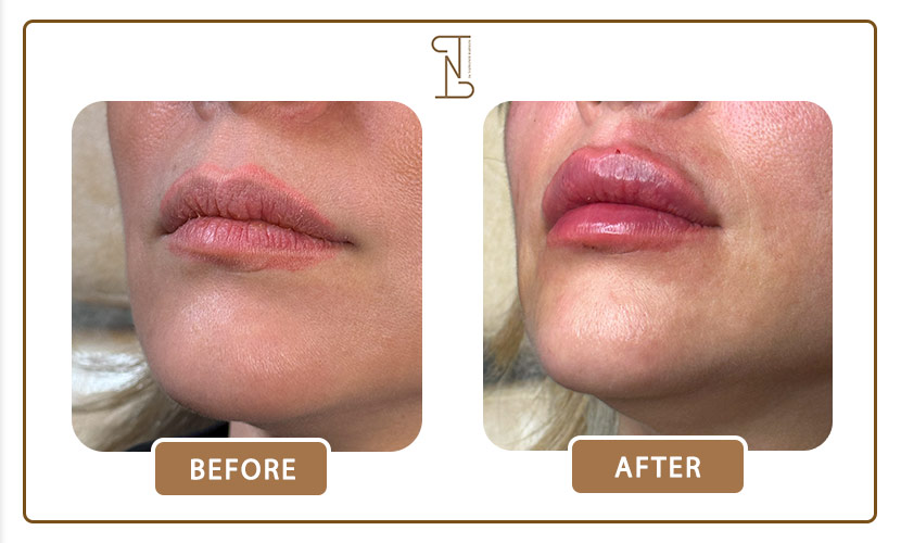 نمونه-کار-فیلر-لب-16