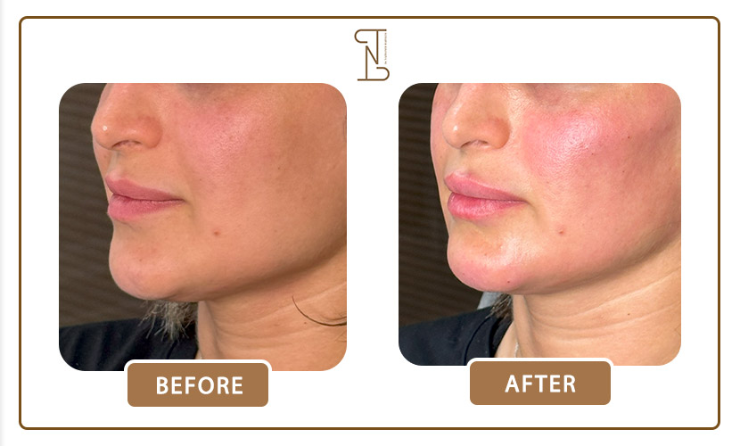 نمونه کار فیلر چانه 10