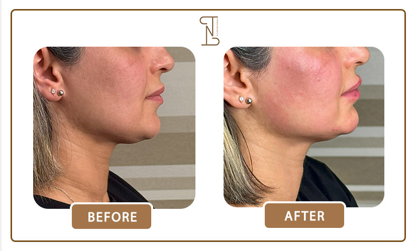 نمونه کار فیلر چانه 10