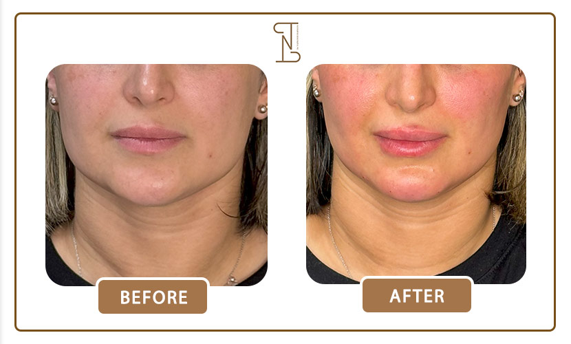 نمونه کار فیلر گونه 2