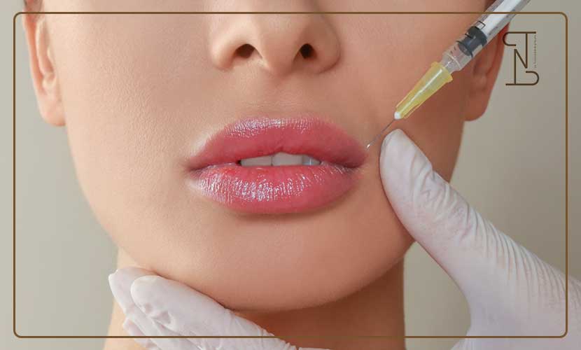 فیلر لب چند روز ورم دارد؟